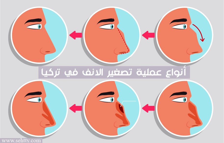 أنواع عملية تصغير الانف في تركيا