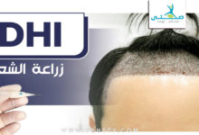 زراعة الشعر بتقنية dhi