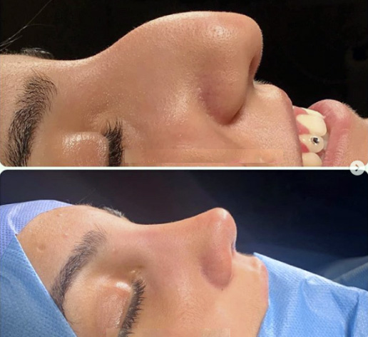 عملية تجميل الأنف في تركيا قبل وبعد