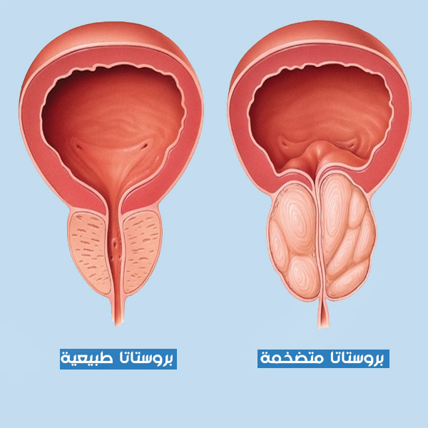 تضخم البروستاتا